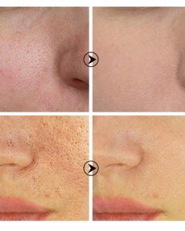 20ml Salicylic Acid Pores Refining Cream Shrink Pore Improve Acnes Blackheads Whitening Cream Anti-aging Oil Control Skin Care