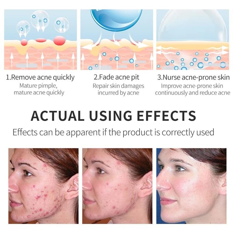 Effective Acne Removal Cream Acne Treatment Anti Acne Repair Fade Acne Spots Oil Control 2101